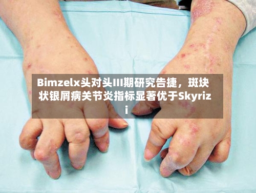 Bimzelx头对头III期研究告捷，斑块状银屑病关节炎指标显著优于Skyrizi